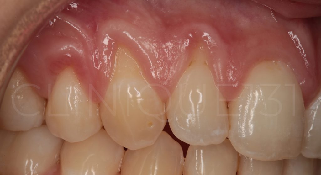 Mal au dent froid et chaud Mal quand je me brosse les dents Clinique 131