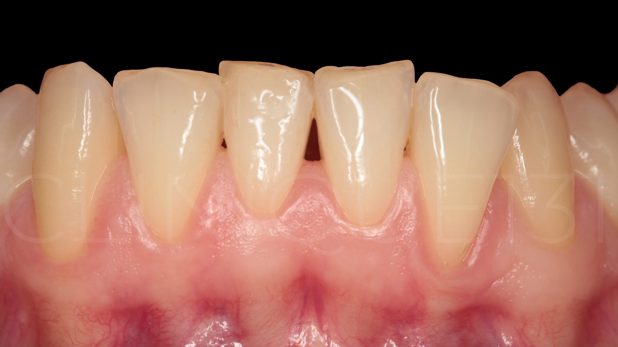 Mes gencives saignent gencives enflammées douloureuses et saignaient au